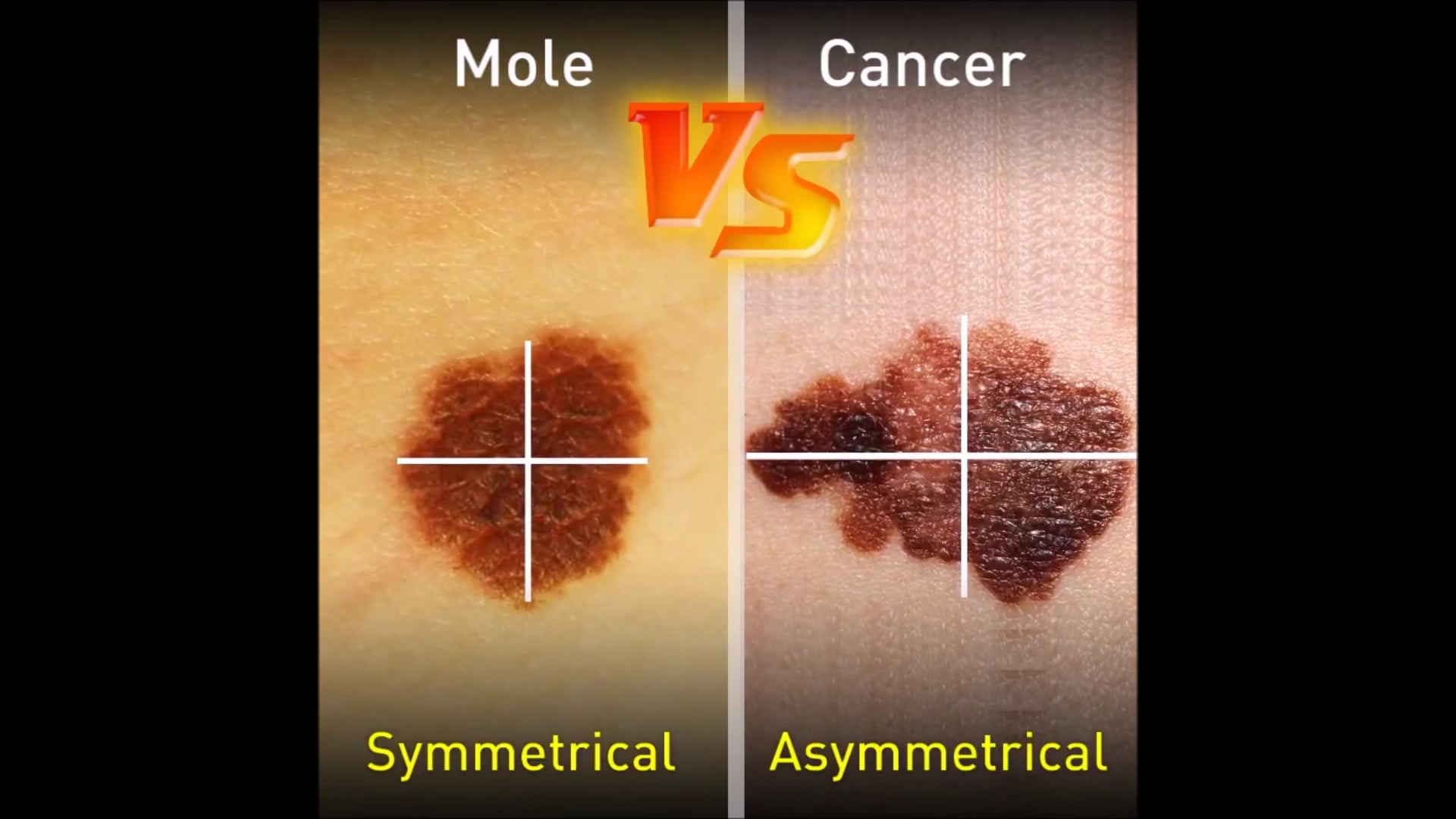 Mole vs Cancer